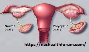 PCOD Complete Guide, PCOD is stand for, Symptoms & Ayurvedic treatment, Diet chart for PCOD, polycystic, & Weight Loss Tips:- 4 PCOD Complete Guide, PCOD is stand for, Symptoms & Ayurvedic treatment, Diet chart for PCOD, polycystic, & Weight Loss Tips:-