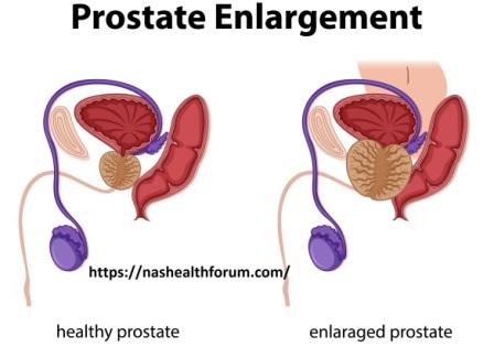What is Prostate/ what are good foods to eat for prostate health/ what are the worst foods for prostate health: 4 What is Prostate/ what are good foods to eat for prostate health/ what are the worst foods for prostate health: