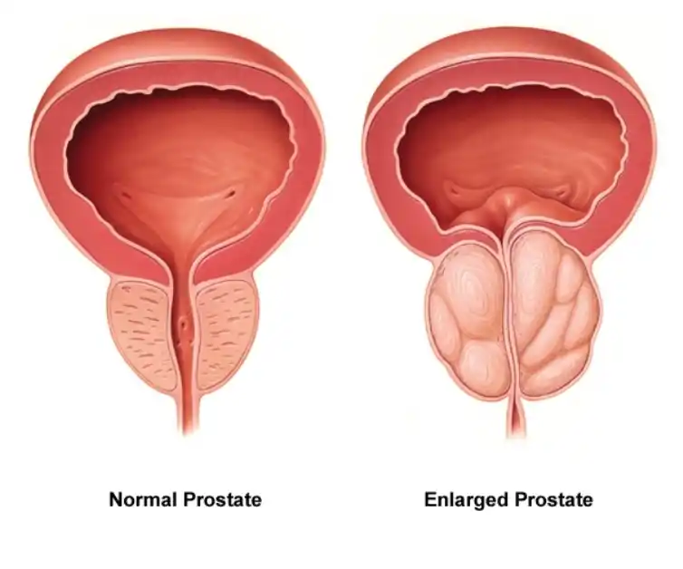 What is Prostate/ what are good foods to eat for prostate health/ what are the worst foods for prostate health: 4 Prostate health