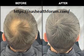 Finasteride and Minoxidil: Promote hair growth:- 5 Finasteride and Minoxidil: Promote hair growth:-